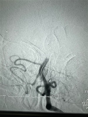 เคสใหม่สำหรับ Dredger Stent Retriever